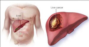 liver cancer